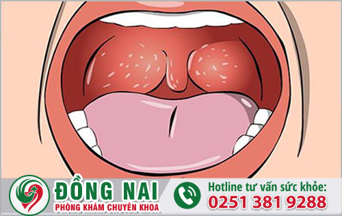 Nguyên nhân và triệu chứng của bệnh lậu ở miệng